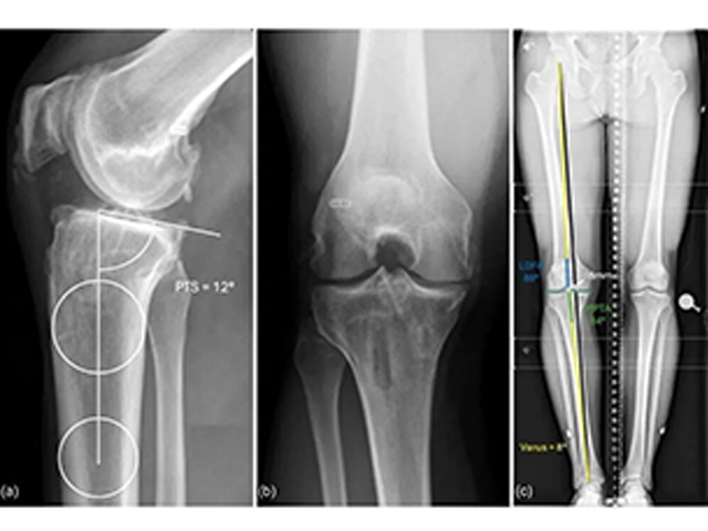 Technical Tips and Tricks for Complex Biplanar High Tibial Osteotomy