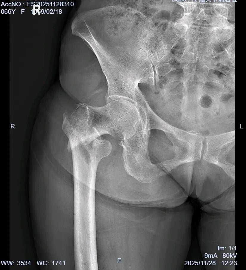 The "Gold Standard Procedure" in Orthopedics: Intramedullary Nailing for Intertrochanteric Fractures – Precise Reduction + Fast Recovery
