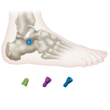 Revolution in the treatment of subtalar joint instability: biomechanical principles of directional stabilizing screws