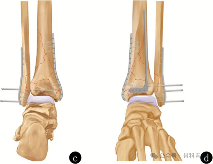 Complex Pilon Fractures: The "Four Principles" and the "Four-Step Foundation Method"