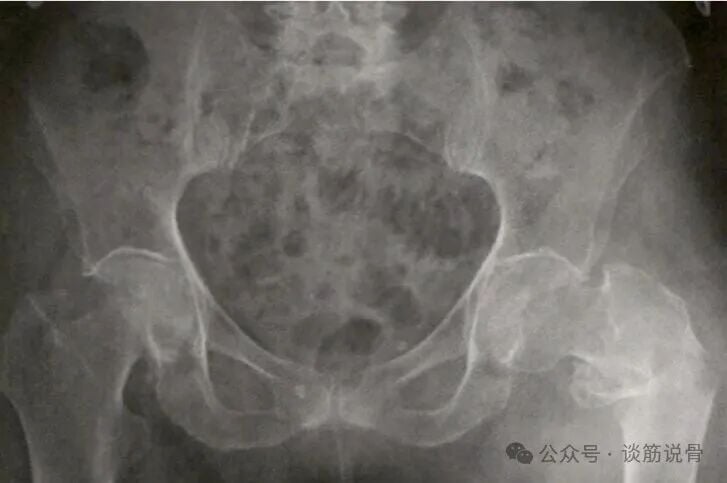 Clinical Decision-Making Between Long and Short Intramedullary Nails for Intertrochanteric Femoral Fractures