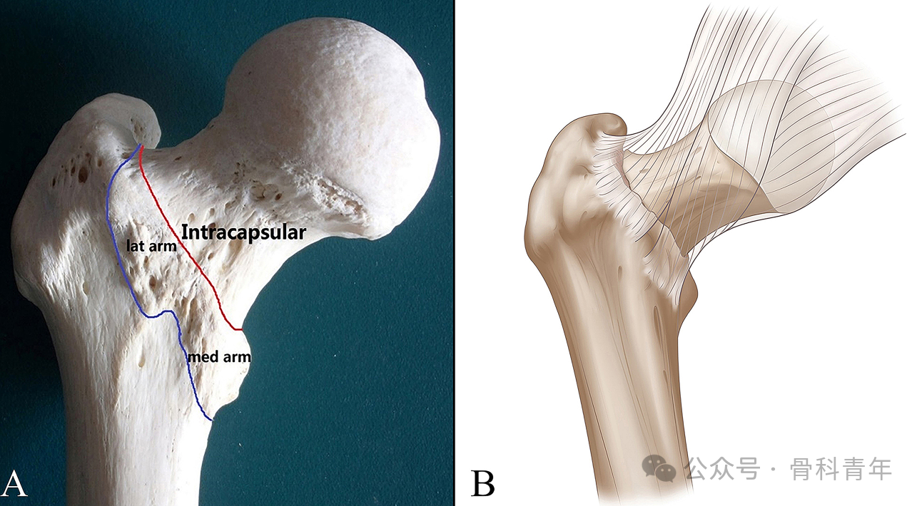 Characteristics and Surgical Techniques of the "Double‑Intra" Type of Irreducible Intertrochanteric Fractures