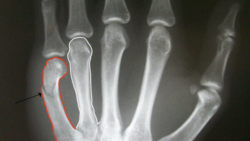 X-ray interpretation (ABCS approach)