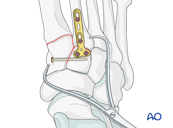 IV. Approach Preparation