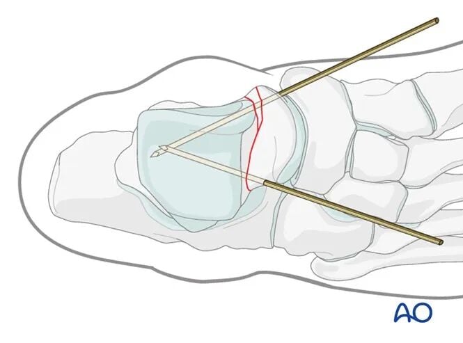 AO Standard Surgery: Screw Fixation for Displaced Talar Neck Fractures