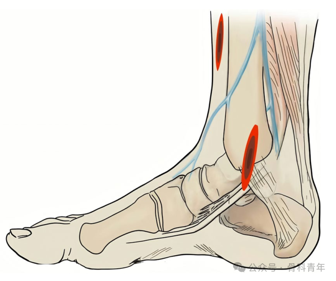 Complex Pilon Fractures: The "Four Principles" and the "Four-Step Foundation Method"