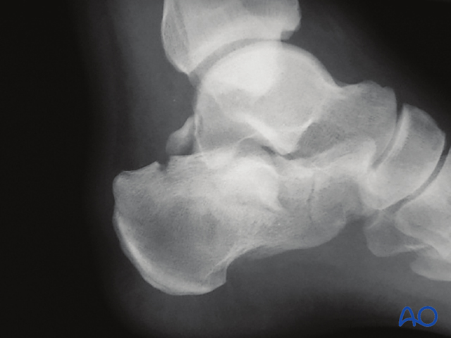 The Extended Lateral Approach to the Calcaneus – The Large L-Shaped Incision