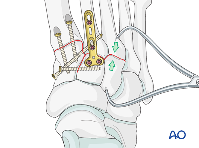 IV. Approach Preparation