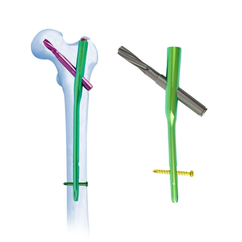 PFNA Nails for Femoral Intertrochanteric Fractures Supporting Elderly Patient Recovery