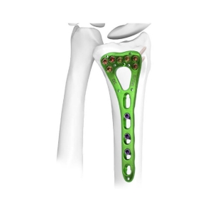 Radius Plates Supporting Recovery for Patients with Radius Fractures