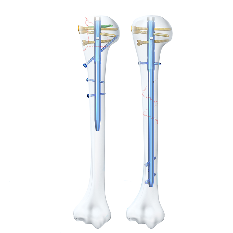 Usine leader de clous huméraux pour des solutions orthopédiques de qualité